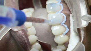 chirurgie d'implant dentaire
