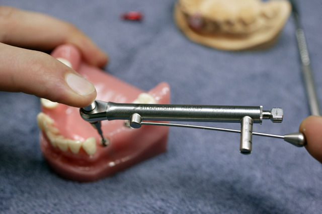 chirurgie d'implant dentaire